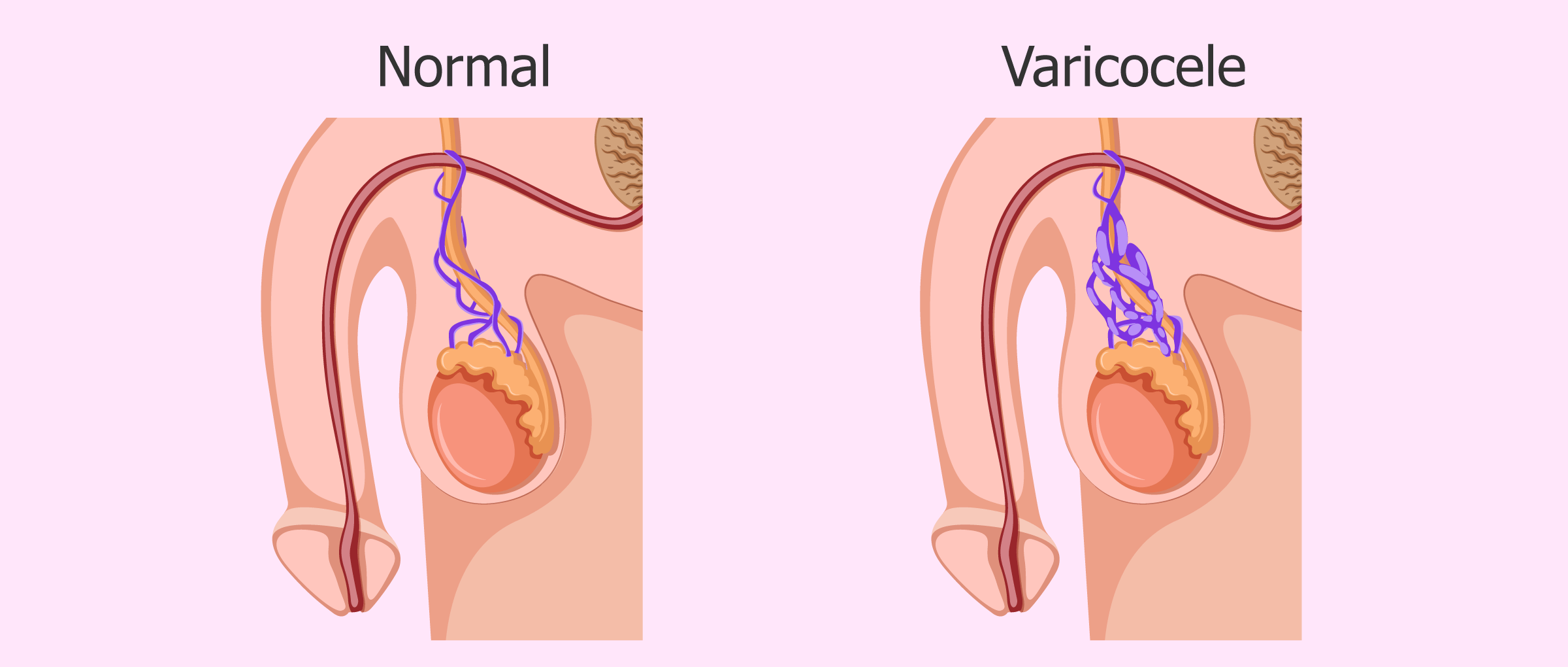 https://urocoral.com/wp-content/uploads/2024/11/varicocele.png